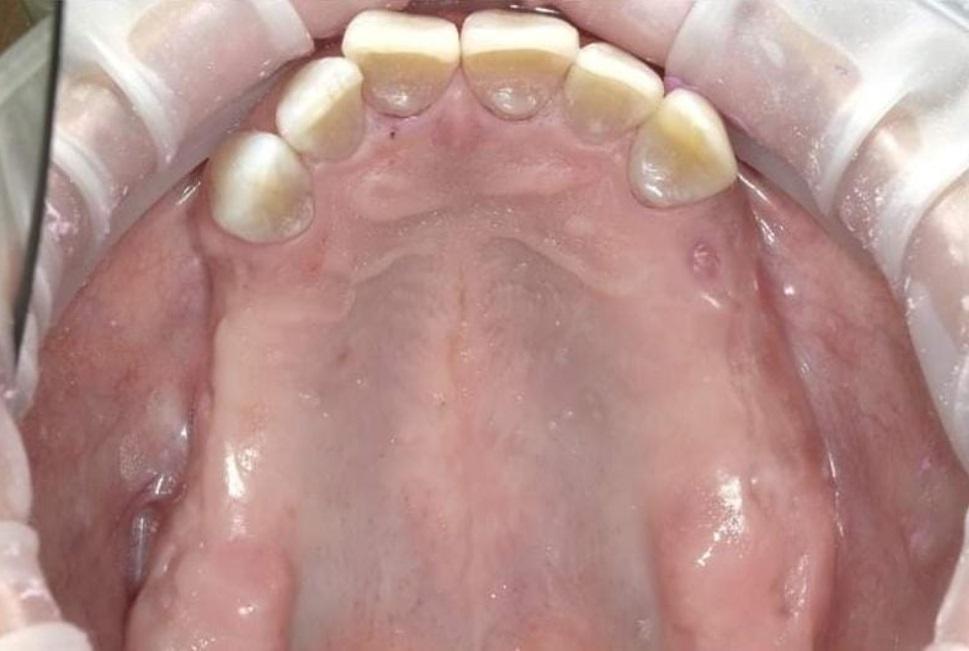Partial Denture before