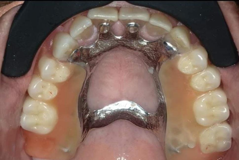 Partial denture after